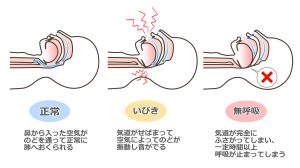 いびきと睡眠時無呼吸症候群の違い