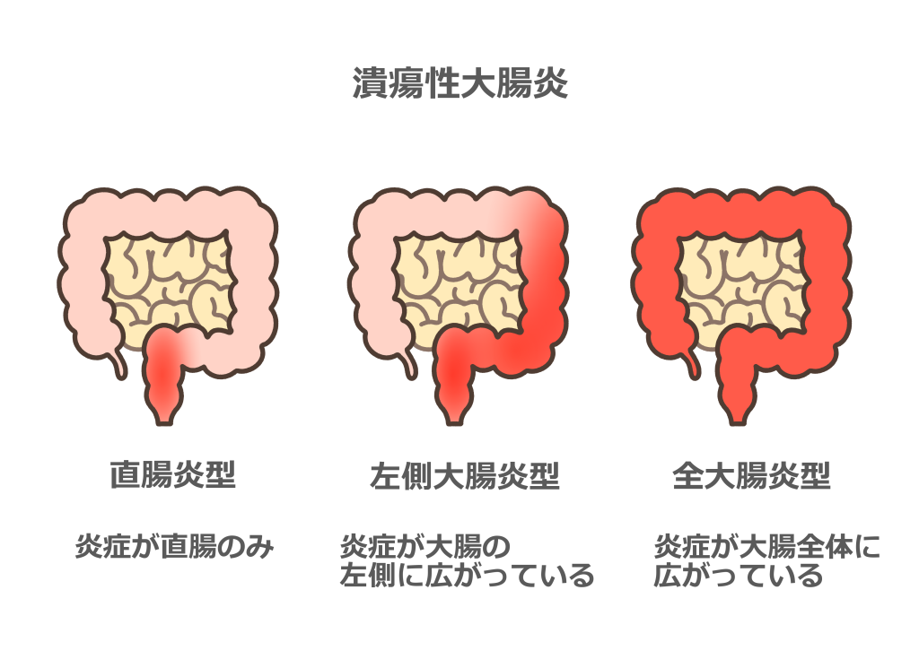 潰瘍性大腸炎 イラスト