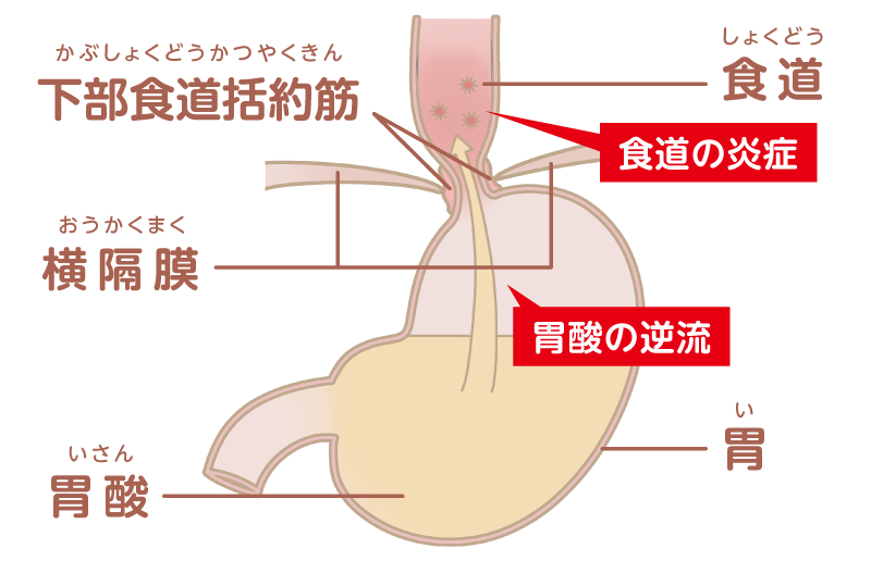 逆流性食道炎の図